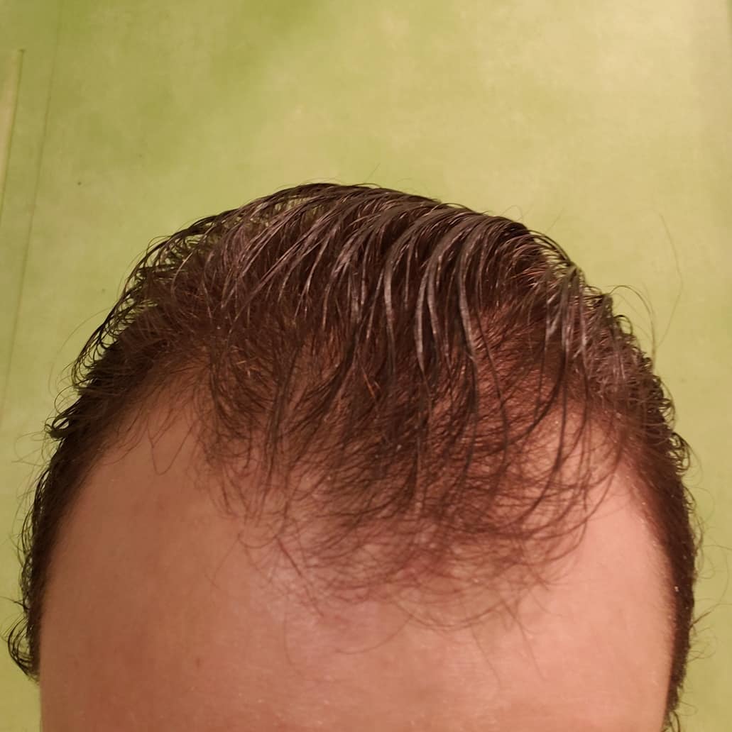 my hair is thinning